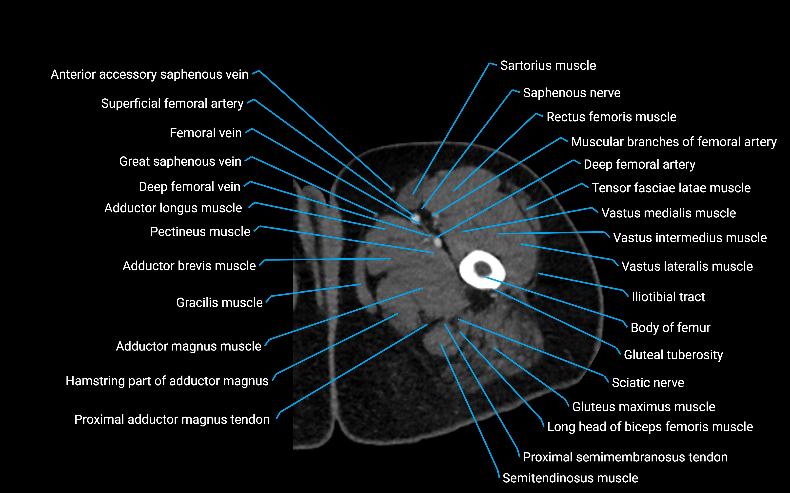 CT Hip axial cross sectional anatomy labelled image 25 (3).png